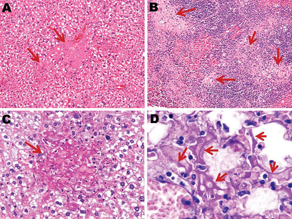 Photomicrographs of liver, spleen, and lung sections from influenza virus A (H5N1)–infected mice at endpoint. Necrotic foci (arrows) scattered throughout the liver (A) (original magnification ×200) and spleen (B) (original magnification ×100) from subtype H5N1–infected mice (hematoxylin and eosin stain); these foci are absent from subtype H1N1–infected mouse livers. C) Necrotic foci in the liver stain periodic acid–Schiff (PAS)–positive (arrow), which suggests focal accumulation of glycogen (ori