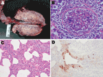 Thumbnail of Postmortem samples from clinically affected pigs, Argentina, 2009. A) Macroscopic lung lesions with distinctive scattered dark-red foci of lobular consolidation (chessboard-like) in all lobes. B) Severe necrotizing bronchiolitis with partially denuded epithelia. Hematoxylin-eosin stain; original magnification ×400. C) General view of the alveolar walls showing moderate interstitial thickening by leukocytes. Hematoxin-eosin stain; original magnification ×200. D) Bronchioli. Positive-