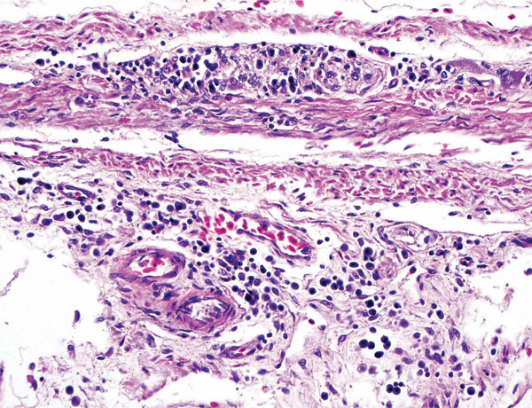 Proventriculus wall from conure PG8 showing characteristic lymphoplasmacytic infiltration of the subserosal enteric ganglia as well as infiltration of submucosa. This bird had been inoculated 55 days earlier with avian bornavirus, genotype 4. Original magnification ×325.