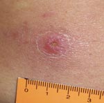 Thumbnail of Inoculation eschar on the lumbar region of the back of a patient infected with a Rickettsia sp. from the Atlantic rainforest in the state of São Paulo, southeastern Brazil.
