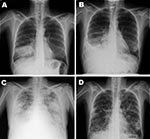 Thumbnail of Chest radiographs of 37-year-old, HIV-positive woman with severe pandemic (H1N1) 2009 virus infection, 2009. A) June 24, alveolar infiltrate in the right lower lobe. B) July 3, minimal pleural effusion, alveolar infiltrate on right lower lobe, and possibly left lower lobe infiltrate. C) July 6, bilateral alveolo-intertitial infiltrates. D) July 29, bilateral peribroncovascular thickening with fibro-cicatricial changes; conserved lung volumes.