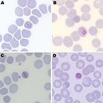 Thumbnail of Giemsa-stained thin blood films of patient infected with Plasmodium knowlesi, showing a ring form (A), a trophozoite with Sinton and Mulligan stippling (B), a band form resembling P. malariae (C), and an early schizont (D). Original magnification ×100.