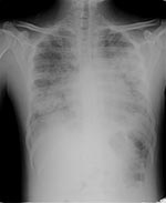 Thumbnail of Radiograph (anteroposterior view) of patient with acute respiratory distress syndrome and oseltamivir-resistant pandemic (H1N1) 2009 virus.