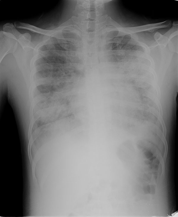 Radiograph (anteroposterior view) of patient with acute respiratory distress syndrome and oseltamivir-resistant pandemic (H1N1) 2009 virus.