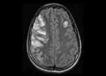 Thumbnail of Magnetic resonance image of the head of the patient, a 13-year-old boy, showing multiple areas of infarction bilaterally with the largest in the right middle cerebral artery distribution and a smaller one in the left frontal region consistent with embolic infarcts.
