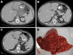 Thumbnail of Radiologic and pathologic findings of Granulibacter bethesdensis infection in patient 2, a 36-year-old man from the United States with X-linked chronic granulomatous disease. A) Contrast-enhanced computed tomography (CT) image at initial examination (December 2005), showing multiple lucencies in the spleen (arrows) and edema and stranding in the omentum and mesentery. B) Contrast-enhanced CT image (September 2006), showing resolution of splenic lesions after prolonged antimicrobial