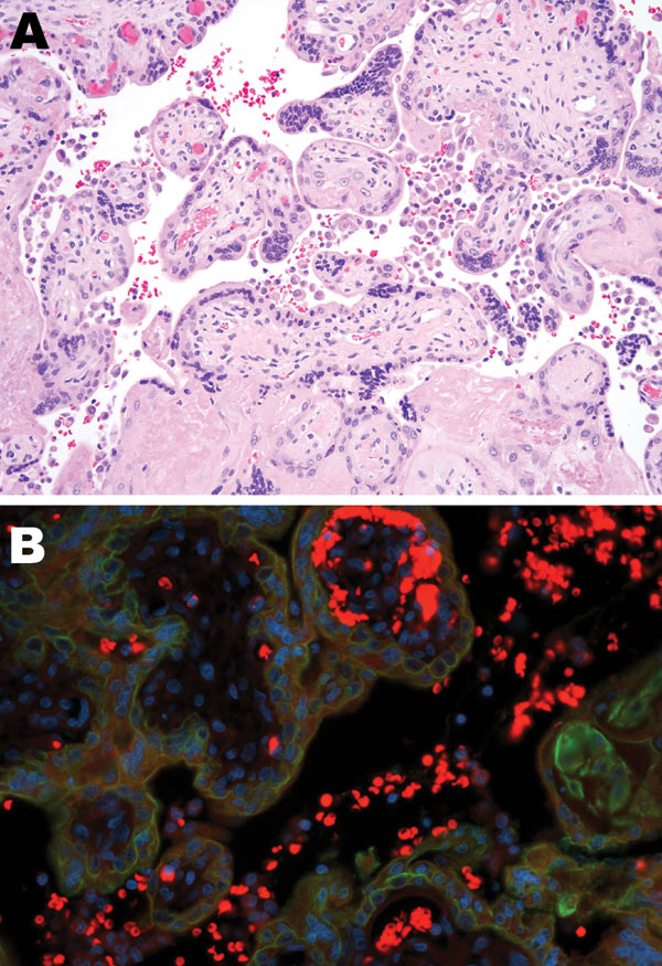 Tissue sample from 30-year-old primigravida patient exposed to seasonal influenza (H1N1). A) Intervillous (maternal) spaces with clusters/sheets of histiocytes (chronic intervillositis) and fibrotic fetal chorionic villi with Hofbauer cells–histiocytic inflammation (hematoxylin and eosin stain, original magnification ×200). B) Dual-stained immunofluorescent assay showing antibodies to influenza A virus (H1N1) (tetramethylrhodamine isothiocyanate, red) and cytokeratin (fluorescein isothiocyanate,