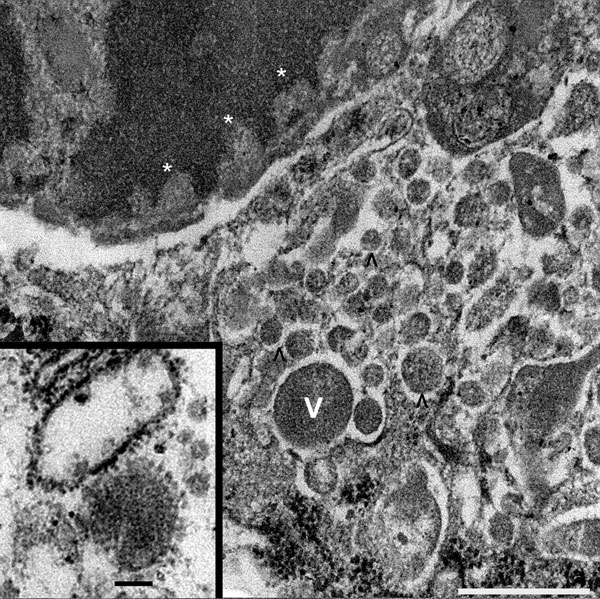 Tissue sample from 30-year-old primigravida patient exposed to seasonal influenza (H1N1). Electron microscopy (original magnification ×70,000) of maternal intervillous space and fetal chorionic villi, showing intranuclear viral transcription aligning along the nuclear envelope–electron hypodensities (asterisks), and intracytoplasmic viral production in varying stages shown by numerous electron densities (V and ^). Scale bar = 500 nm. Inset: enlarged image of mature virion with capsular projectio