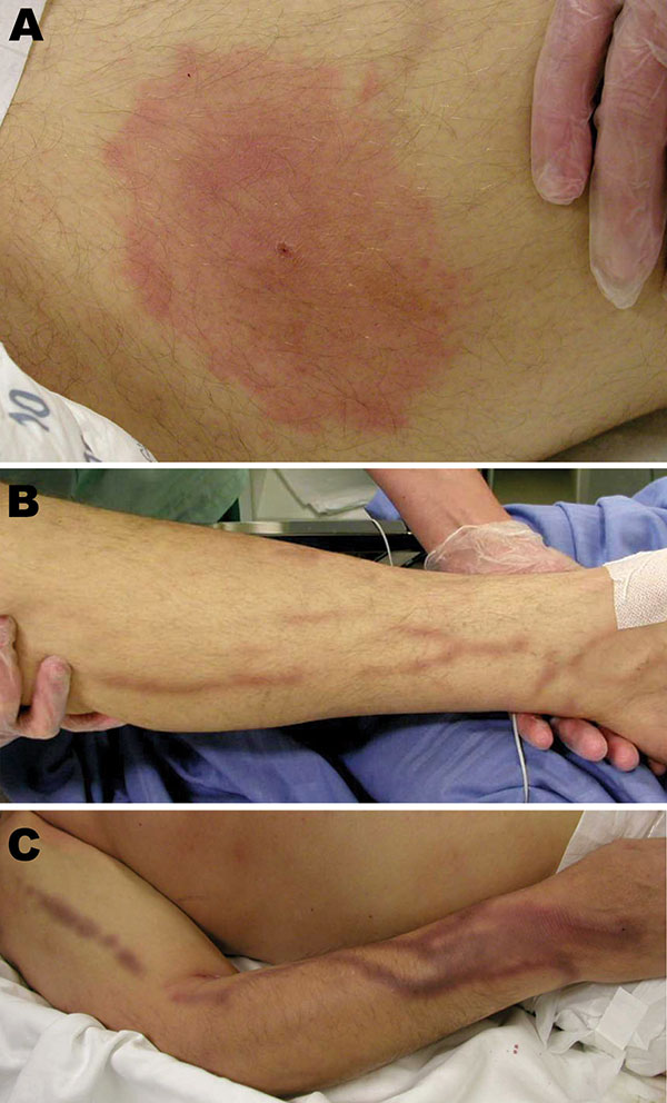 Lesions of the patient infected with Babesia divergens 1 day after hospitalization, Finland, 2004. A) Left thigh showing a classical erythema chronicum migrans lesion; B) left leg and C) right arm showing dark purple streaks.