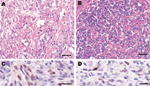 Thumbnail of Histologic patterns of cutaneous Kaposi sarcoma (KS) associated with a human herpesvirus 8 (HHV-8) type E infection. Patient 1: A) The spindle cells were organized as bundles, forming vascular slit-like spaces containing erythrocytes. Some macrophages containing hemosiderin were observed (data not shown). Scale bar = 25 μm. C) Immunohistochemical testing showed a positive signal for HHV-8 infection (latent nuclear antigen [LANA-1]) and CD34 (data not shown). The Perls staining also