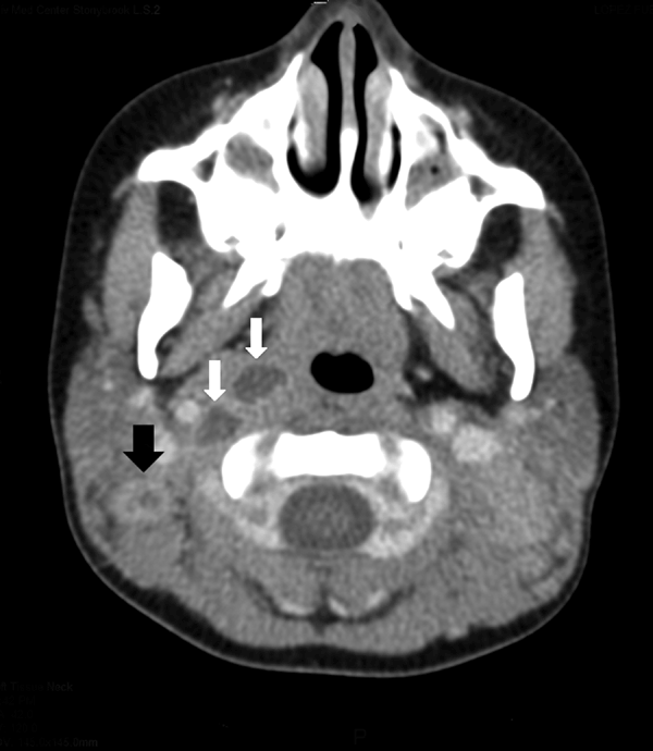 Computed tomography scan of the neck of a 3-year-old girl, showing right lateral retropharyngeal abscess (white arrows) and enlarged bilateral posterior cervical lymph nodes with low attenuation of a right cervical lymph node (black arrow), consistent with atypical mycobacterium adenitis.