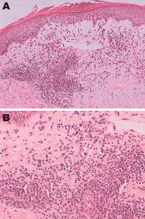 Histologic analysis of a skin biopsy specimen of a 28-year-old patient with erythema migrans, showing characteristics of erythema migrans. The epidermis shows parakeratosis, microvesicle formation, lichenoid interface, dermal edema, and perivascular chronic inflammatory cell infiltrates. Original magnification ×20 (A) and ×40 (B).