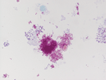 Thumbnail of Gimenez stain of Bartonella henselae obtained by the culture in human embryonic lung of the skin biopsy of a patient with cat scratch disease, France, 2010. Original magnification ×100.