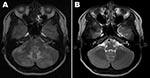 Thumbnail of Magnetic resonance imaging (MRI) scans of case-patient’s brain. A) MRI at hospital admission shows ill-defined T2 changes in both cerebellar hemispheres, periventricular white matter, and the pons. B) MRI of the brain 1 month later, showing nearly complete disappearance of the changes observed at admission.