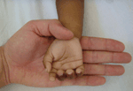 Thumbnail of Hand of a 2-year-old child (patient no. 1) with severe anemia (hemoglobin level 3.6 g/dL), showing intense pallor, compared with the hand of a healthy physician. Photograph provided by authors.