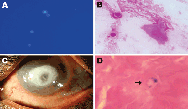 A) Spherical cysts of Dictyostelium spp. in potassium hydroxide (calcoflour white stain; original magnification ×40) preparation. B) Spherical double wall cysts of Dictyostelium spp. (Gram stain; original magnification ×100). C) Cornea of the patient’s left eye, showing a ring-shaped central infiltrate and central thinning. D) Corneal button showing Dictyostelium spp. cysts (arrow; hematoxylin and eosin stain; original magnification ×100).
