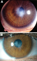 Thumbnail of Ameba-associated keratitis in a 17-year-old woman (contact lens wearer), France, showing a paracentral corneal scar (A) and recovery at 13-month follow-up (B). Original magnification ×10.