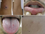 Thumbnail of Lesions on day 6 of illness of patient with eschar-associated rickettsial disease, Bahia, Brazil, 2007. A) Eschar on right wrist; B) papular skin rash on left elbow; C) ulcerated lesion on lower lip; D) erosions on tongue mucosa; E) vesicular papular lesions on trunk.