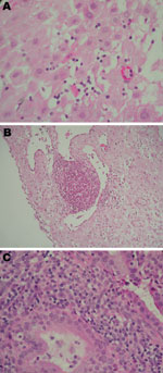 Thumbnail of Placental histologic results (1) from 3 women with real-time PCR–positive results for Chlamydia trachomatis (Table 2). A) Case-patient 390; B) case-patient 235; C) case-patient 564. Histologic analysis shows different degree of periglandular lymphocytes infiltration, with a microabscess in B1. Original magnifications ×600 except B1 (×400).