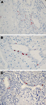 Thumbnail of Immunohistochemical analysis of placentas in Figure 1. These placentas were obtained from 3 patients positive for Chlamydia trachomatis by real-time PCR. A) case-patient 390; B) case-patient 235; C) case-patient 564. Immunohistochemical analysis demonstrated C. trachomatis–infected cells from endometrial glands. Original magnification ×600.