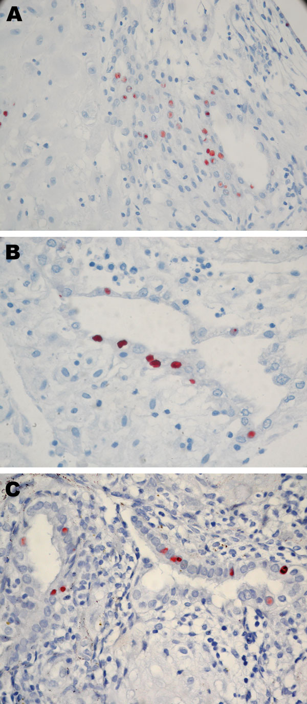 Immunohistochemical analysis of placentas in Figure 1. These placentas were obtained from 3 patients positive for Chlamydia trachomatis by real-time PCR. A) case-patient 390; B) case-patient 235; C) case-patient 564. Immunohistochemical analysis demonstrated C. trachomatis–infected cells from endometrial glands. Original magnification ×600.