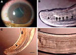 Thumbnail of Corneal edema and episcleral hyperemia in the left eye of a 16-year-old boy from Brazil and a free-swimming filarid in the anterior chamber. A) Macroscopic view. B) Five pairs of ovoid pre-cloacal papillae (arrows) and 1 postcloacal caudal papillae (arrowhead). Scale bar = 50 µm. C) Small (arrowhead) and large (arrow) spicules. Scale bar = 40 µm. D) Longitudinal ridges of the area rugosa. Scale bar = 50 µm.