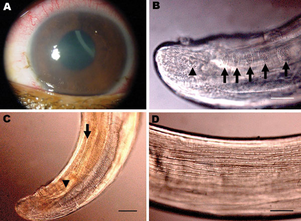 Corneal edema and episcleral hyperemia in the left eye of a 16-year-old boy from Brazil and a free-swimming filarid in the anterior chamber. A) Macroscopic view. B) Five pairs of ovoid pre-cloacal papillae (arrows) and 1 postcloacal caudal papillae (arrowhead). Scale bar = 50 µm. C) Small (arrowhead) and large (arrow) spicules. Scale bar = 40 µm. D) Longitudinal ridges of the area rugosa. Scale bar = 50 µm.