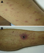 Thumbnail of Evidence of acute infection of the skin and subcutaneous tissue in patient admitted for treatment of scrub typhus-like symptoms in Chile. A) Rash on admission, left arm. B) Necrotizing eschar with erythematous halo over the left leg.