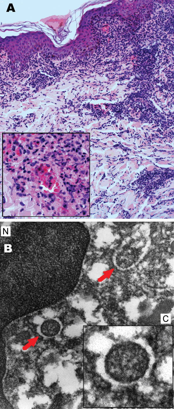 Results of biopsy analysis of tissue sample from eschar on the left leg of patient admitted for treatment of scrub typhus–like symptoms, Chile. A) Leukocytoclastic vasculitis. Hematoxylin and eosin stained; original magnification ×200, inset ×400. B) Endothelial cell, showing nucleus (N) within the cytoplasm (C, inset). Arrows show similar round and oval organisms, electron-dense, surrounded by electron-lucent halo of rickettsial type microorganisms. Electron microscopy; original magnification ×