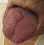 Thumbnail of Mycobacterium bovis lesion on the tongue of patient 2, the Netherlands.