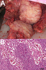 Thumbnail of A. A) Enlarged mediastinal lymph nodes of a stranded, pregnant, harbor porpoise (Phocoena phocoena) infected with Cryptococcus gattii that was transmitted to its fetus. B) Mucicarmine–stained sections of fetal mediastinal lymph node, showing C. gattii extracellular yeast aggregates (original magnification ×20). Scale bar = 50 μm.