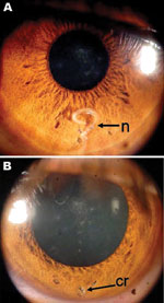 Thumbnail of Eye of the patient, a 29-year-old man from Brazil. A) Nematode (n) between muscle fibers of the iris. B) Iris after surgery, showing a mild residual scar (cr) in the region where the nematode had been located.