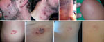 Thumbnail of Vaccinia lesions in patients with secondary and tertiary cases, New York, USA, 2010. Top row, case-patient 1; bottom row, case-patient 3.