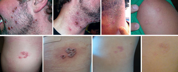 Vaccinia lesions in patients with secondary and tertiary cases, New York, USA, 2010. Top row, case-patient 1; bottom row, case-patient 3.