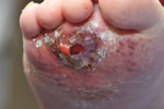 Thumbnail of Infected wound, initially thought to be caused by an insect bite, on the right foot of a 16-year-old girl who was wheelchair-bound because of spinal muscular atrophy type II, the Netherlands.