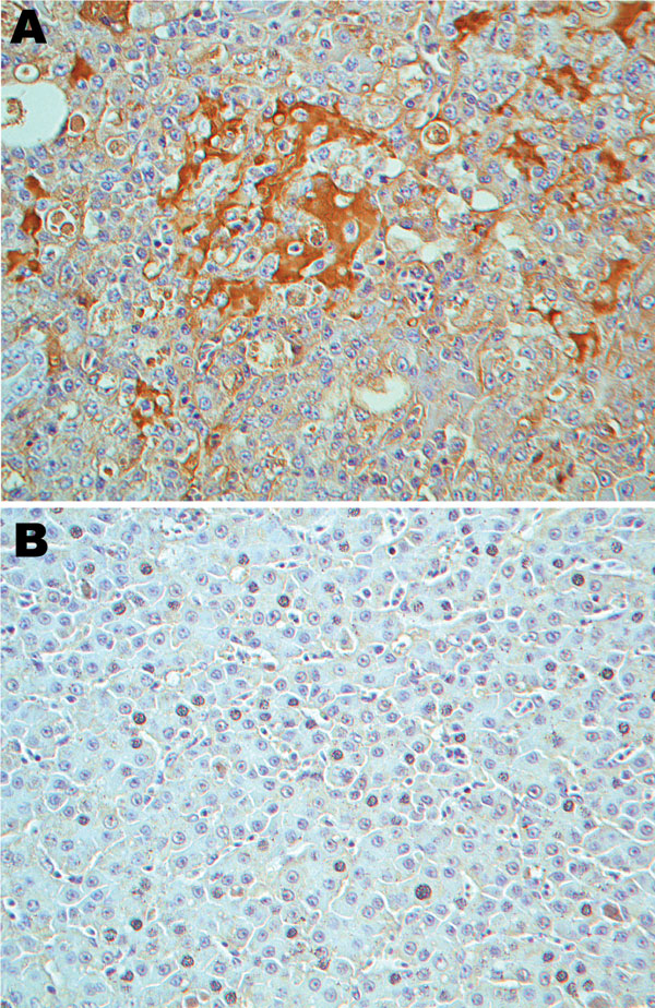 Immunohistologic staining of liver tissues with serum from a turkey poult with turkey viral hepatitis (TVH). Serum sample from PCR-positive poult 394.9 demonstrates turkey hepatitis virus (THV) antigens in clusters of cells in liver tissue of TVH-affected poult 2993A (A) but not in liver sections from nondiseased poult 1927B (B). Sections were counterstained with hematoxylin. Brightfield microscopy images; original magnification ×40.