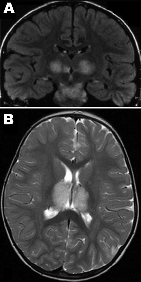 A) Magnetic resonance image of brain corona of patient 1, a 6-year-old boy with acute necrotizing encephalopathy (ANE). B). Axial-weighted images of brain thalami of patient 2, a 22-month-old girl with ANE, the cousin of patient 1.