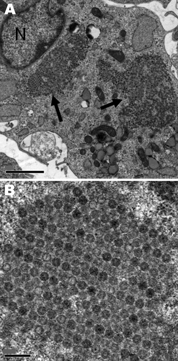 Electron microscopic images of the cytopathic effect induced in MRC5 cells by a reovirus isolate from throat specimens of patient 2, a 22-month-old girl with acute necrotizing ancephalopathy. N, nucleus; arrows indicate viral intracytoplasmic inclusions. Scale bars indicate 2 µm (A) or 0.2 µm (B).