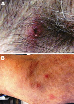 Thumbnail of Images of lesion in the patient caused by bite from lone star tick. A) Erythematous circular lesion in right armpit at site of tick bite with induration and a necrotic center. B) Maculopapular rash involving the inferior portion of the arm. Source: Julie M. Bradley.
