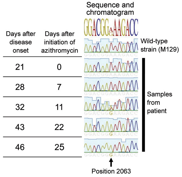 Time elapsed and chromatogram of wild-type Mycoplasma pneumonia strain M129 (ATCC 29342) compared with results from 5 samples from a 6-year-old boy in Israel. The A2063G mutation is shown to be evolving during treatment and predominates at the end.