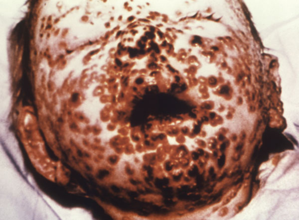 One-year-old child on day 10 of a smallpox infection; his face is covered with painful lesions that are beginning to scab. Photograph courtesy of the Centers for Disease and Prevention Public Health Image Library; by Charles Farmer, Jr., 1962.