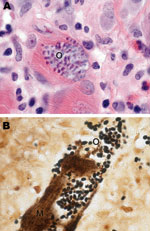 Thumbnail of Skeletal muscle tissue samples from a 67-year-old woman with Tubulinosema sp. infection, 2009. A) Hematoxylin and eosin stain shows inflamed fibers with mononuclear infiltrate (O). B) Warthin-Starry silver stain shows abundant clusters of ovoid, basophilic organisms (O) within the muscle fibers (M). Original magnifications ×1,000.