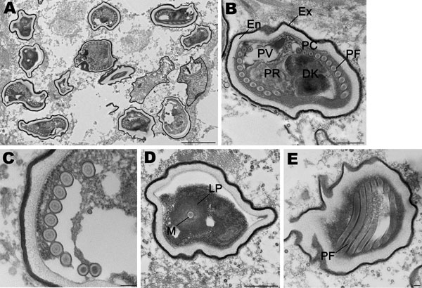 Spores of Tubulinosema sp. from a 67-year-old woman with Tubulinosema sp. infection, 2009. A) Electron micrograph of numerous spores in various stages in muscle tissue. Scale bar = 2 μm. B) An immature spore showing an electron-dense exospore (Ex) and a thick electron-lucent endospore (En), which together compose the spore wall. Diplokaryon (DK), posterior vacuole (PV), ribosomes in crystalline clusters as polyribosomes (PR) along with the polaroplast and polar filaments (PF) constitute the spor