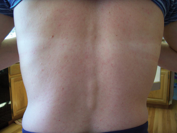 Maculopapular rash on patient 3 infected with Zika virus, Colorado, USA.