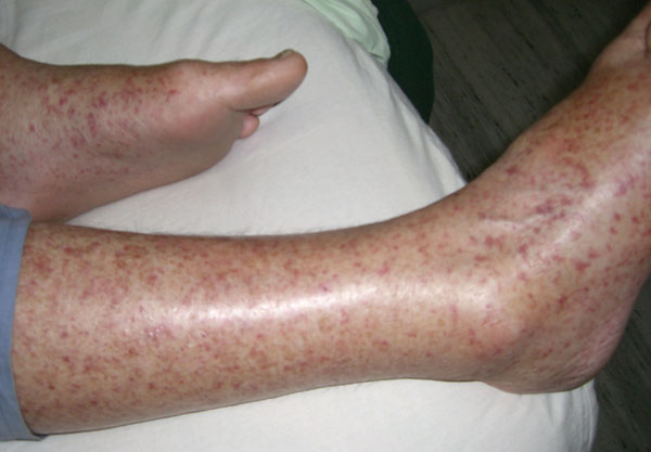 Rash exhibited by patient infected with Rickettsia honei, Nepal, 2009.
