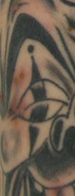 Thumbnail of Pustular rash caused by Mycobacterium haemophilum confined to the tattooed region of the forearm. Photograph taken in October 2009, two months after tattooing.