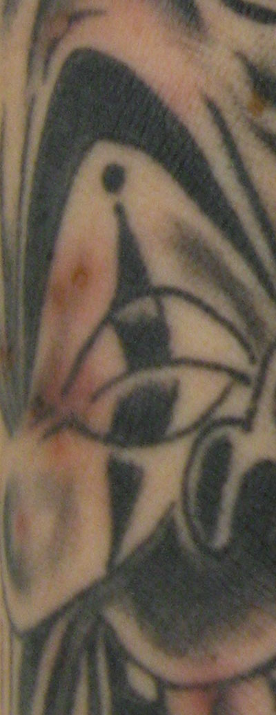 Pustular rash caused by Mycobacterium haemophilum confined to the tattooed region of the forearm. Photograph taken in October 2009, two months after tattooing.