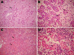 Thumbnail of Microscopy findings of autopsy specimens from a 12-day-old girl with yellow fever, Brazil, 2009. A) Massive liver necrosis, with proliferation of ductular-like structures around portal tracts (arrow); B) hepatocytes with microvesicular fatty changes (arrows); C) intra-alveolar lung hemorrhage (arrows); D) renal tissue showing acute tubular necrosis (arrows). Panels A and C, original magnification ×200; panels B and D, original magnification ×400.