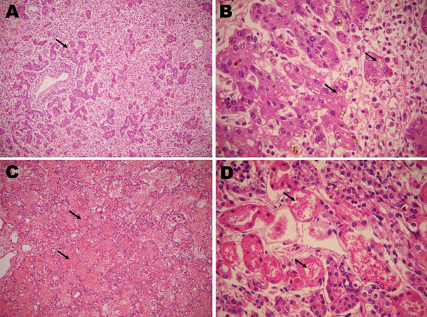 Microscopy findings of autopsy specimens from a 12-day-old girl with yellow fever, Brazil, 2009. A) Massive liver necrosis, with proliferation of ductular-like structures around portal tracts (arrow); B) hepatocytes with microvesicular fatty changes (arrows); C) intra-alveolar lung hemorrhage (arrows); D) renal tissue showing acute tubular necrosis (arrows). Panels A and C, original magnification ×200; panels B and D, original magnification ×400.
