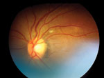 Thumbnail of Retinal image from patient with evidence of choroidal tuberculosis.